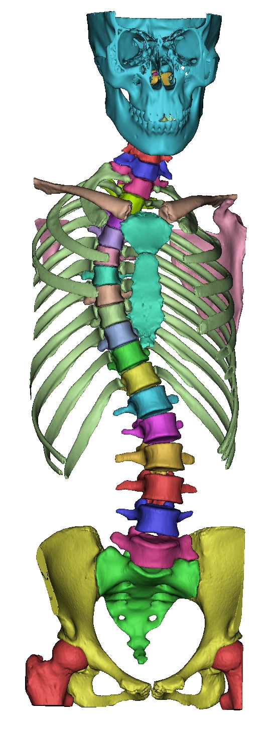 脊柱侧弯全套骨骼3D打印模型