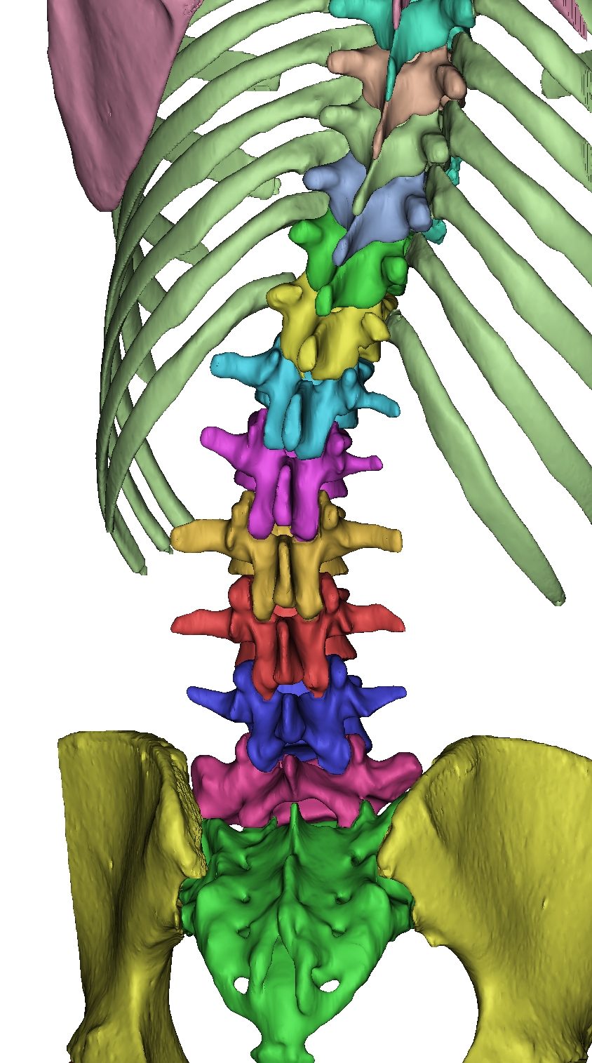 脊柱侧弯全套骨骼3D打印模型