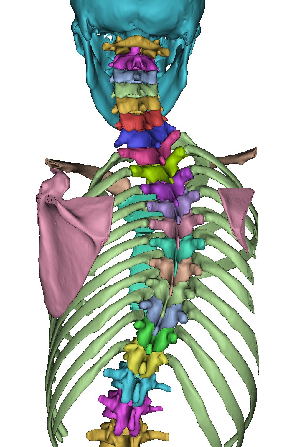 脊柱侧弯全套骨骼3D打印模型